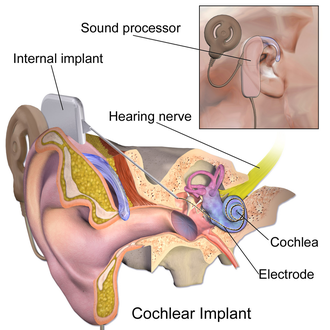 Cochlear Implants: Converting Sound into Electrical Stimulation